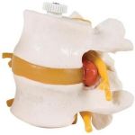 Πρόπλασμα Οσφυϊκών Σπονδύλων με Πρόπτωση Δίσκου | Προπλάσματα - Αφίσες στο Paterakis Medical Group