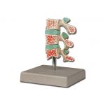 Πρόπλασμα Οστεοπόρωσης | Προπλάσματα - Αφίσες στο Paterakis Medical Group