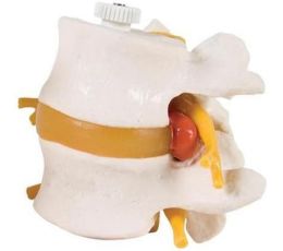 Πρόπλασμα Οσφυϊκών Σπονδύλων με Πρόπτωση Δίσκου | Προπλάσματα - Αφίσες στο Paterakis Medical Group