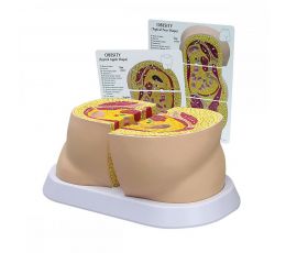 Πρόπλασμα Παχυσαρκίας Ισχίων | Προπλάσματα - Αφίσες στο Paterakis Medical Group