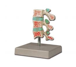 Πρόπλασμα Οστεοπόρωσης | Προπλάσματα - Αφίσες στο Paterakis Medical Group