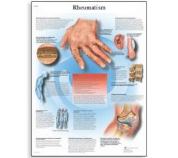 Εκπαιδευτική Αφίσα Ρευματισμών | Προπλάσματα - Αφίσες στο Paterakis Medical Group
