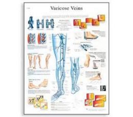 Εκπαιδευτική Αφίσα Κιρσών | Προπλάσματα - Αφίσες στο Paterakis Medical Group