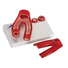 Πρόπλασμα Αρτηριοσκλήρυνσης | Προπλάσματα - Αφίσες στο Paterakis Medical Group